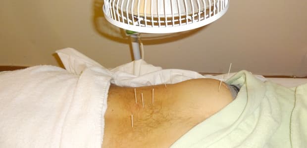 Séance d'acupuncture, fines aiguilles posées sur des points précis