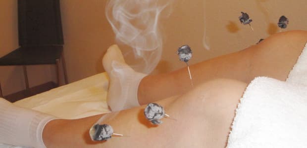 Moxibustion : moxas d'armoise séchée en combustion sur des points d'acupuncture